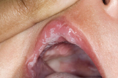 What is thrush in babies?